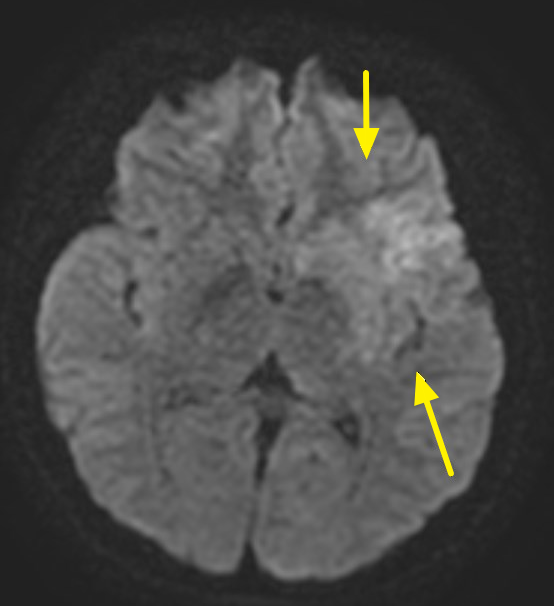 核磁共振影像，箭頭處呈現早期缺血變化 0