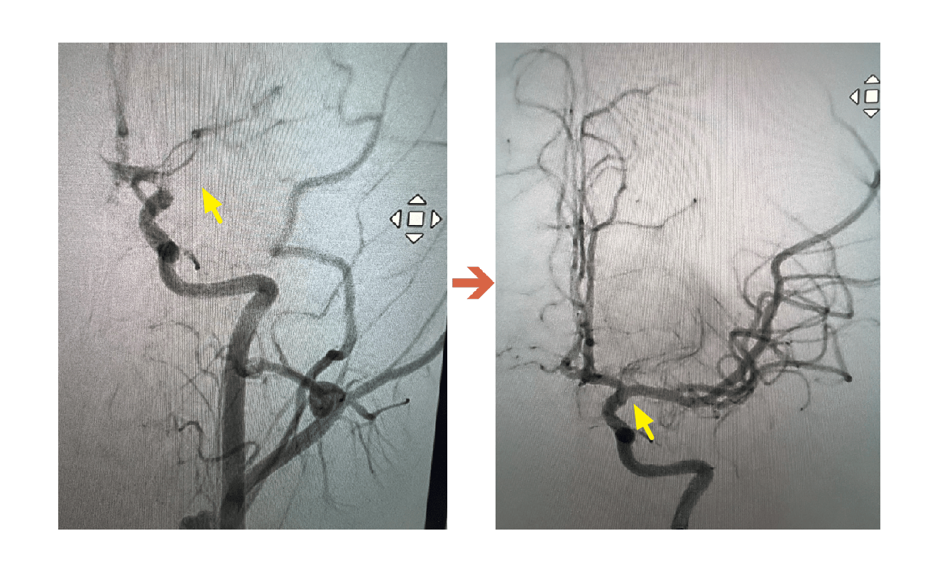 ICA血管攝影阻塞到打通 0